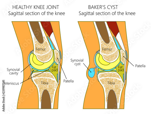 Vector illustration of a healthy human knee joint and unhealthy knee with Baker's cyst. Anatomy of human knee, sagittal section of the knee. for advertising and medical publications