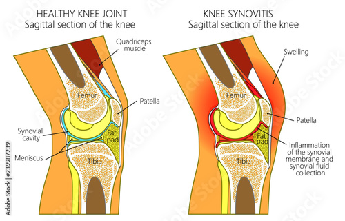 Vector illustration of a healthy human knee joint and unhealthy knee with synovitis. Anatomy of human knee, sagittal section of the knee. for advertising and medical publications