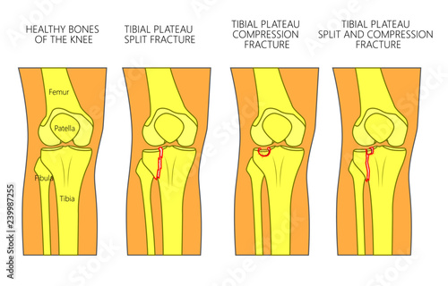 Vector illustration of a healthy bones of human knee and a knee with tibial plateau split, compression or depression fractures. Front view of the knee. For advertising, medical publications