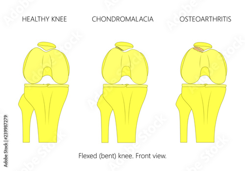 Vector illustration of the healthy knee joint, patellar chondromalacia and Patellofemoral osteoarthritis. Front view of flexed or bent knee. 