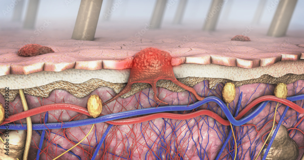 Ταπετσαρία 3d illustration of a cross-section of a diseased skin with melanoma that enters