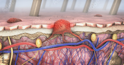 3d illustration of a cross-section of a diseased skin with melanoma that enters the bloodstream and lymphatic tract photo