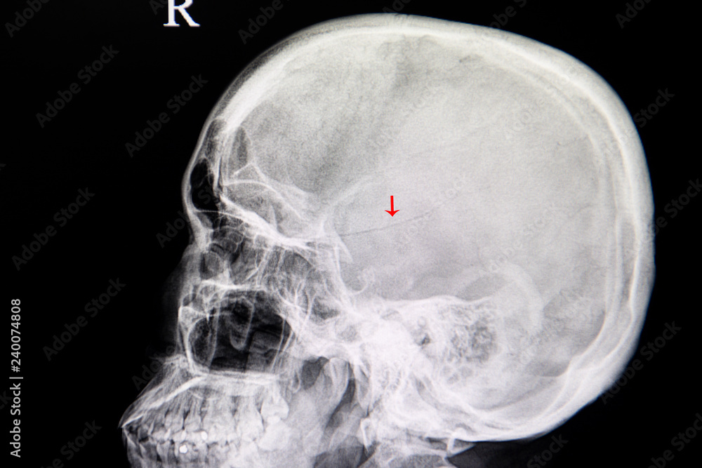 xray image of a patient with linear fracture skull from traumatic
