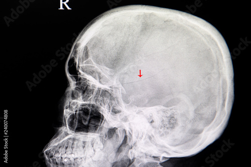 Obraz na plátne xray image of a patient with linear fracture skull from traumatic injury