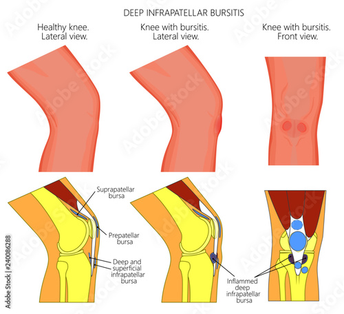 Vector illustration of a healthy knee and unhealthy knee with deep infrapatellar bursitis or clergyman's knee. Anatomy of human knee joint, lateral or side view, anterior or front view.