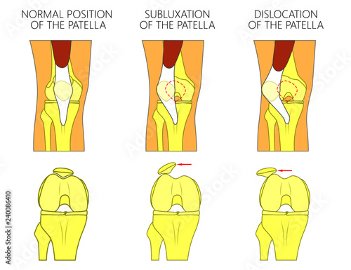 Vector illustration of a healthy human knee joint and unhealthy knees with problem. Subluxation and dislocation of the patella or kneecap. Anatomy of human knee joint, front view of straight and bent 