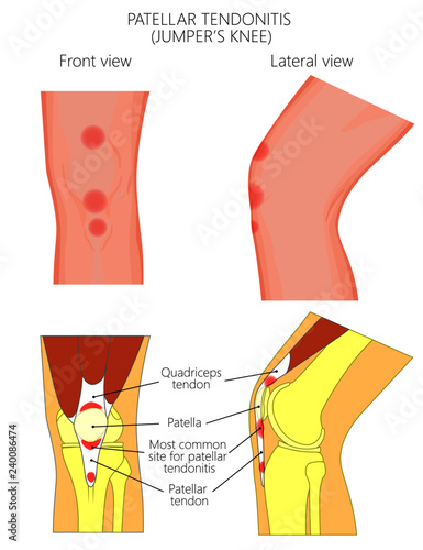 Vector illustration of unhealthy knee joint with patellar tendonitis or jumper knee. Front and lateral or side views of the leg. For advertising and other medical publications