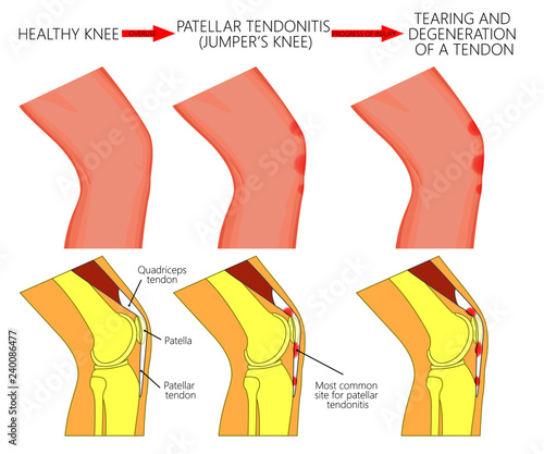 Vector illustration of healthy knee joint and unhealthy knees with patellar tendonitis and progress of disease. Lateral or side view of the leg. For advertising and other medical publications