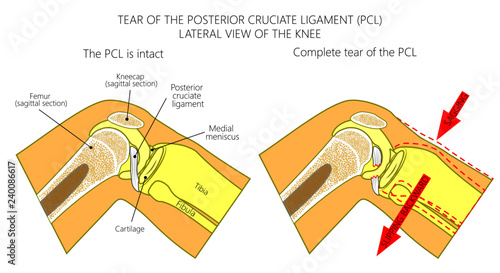 Vector illustration anatomy of a knee joint with healthy and torn posterior cruciate ligament. Side or lateral view of flexed knee with sagittal section of femur bone. For medical publications