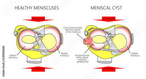 Vector illustration of a proximal surface of tibia in a healthy human knee joint and unhealthy knee with horizontal tear of meniscus and meniscal cyst. For advertising and medical publications