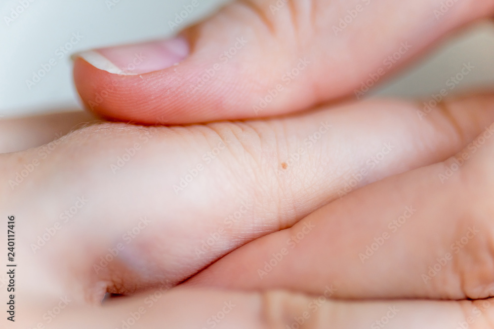 a birthmark or a mole on a woman skin a birthmark or a mole on a woman skin