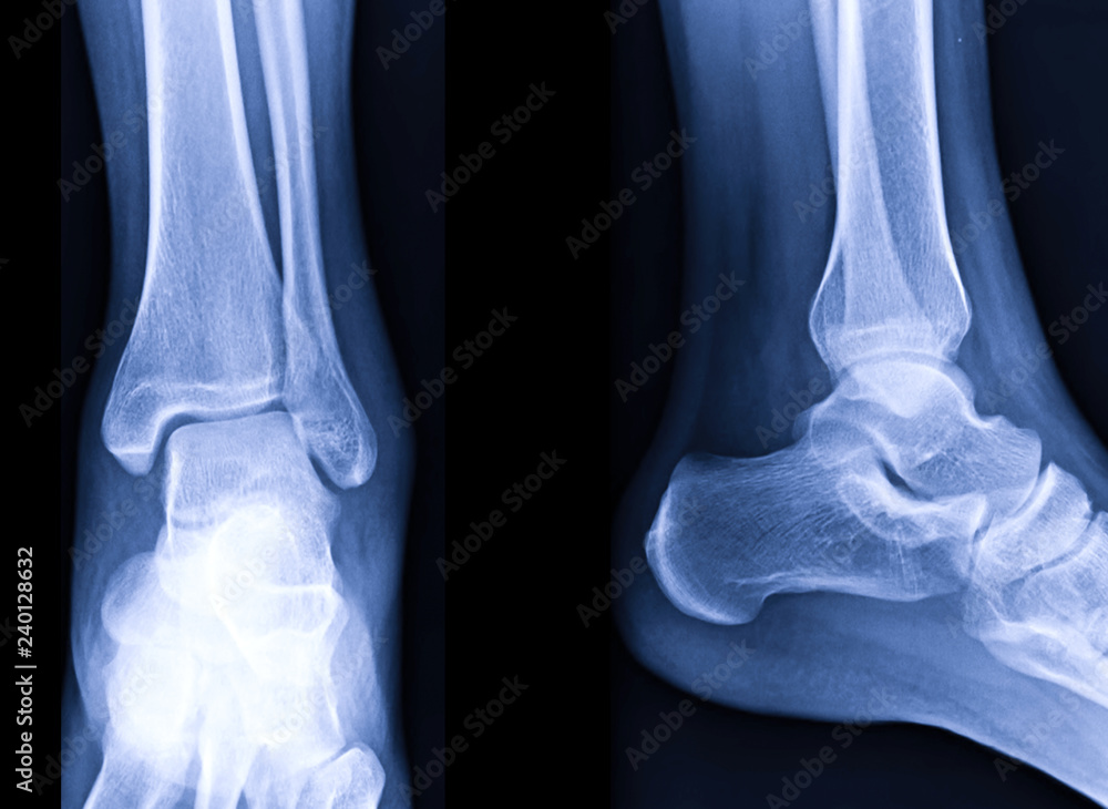 Radiographic image or xray image of Left ankle joint. Stock Photo Adobe Stock Radiographic image or xray image of Left ankle joint. Stock Photo Adobe Stock