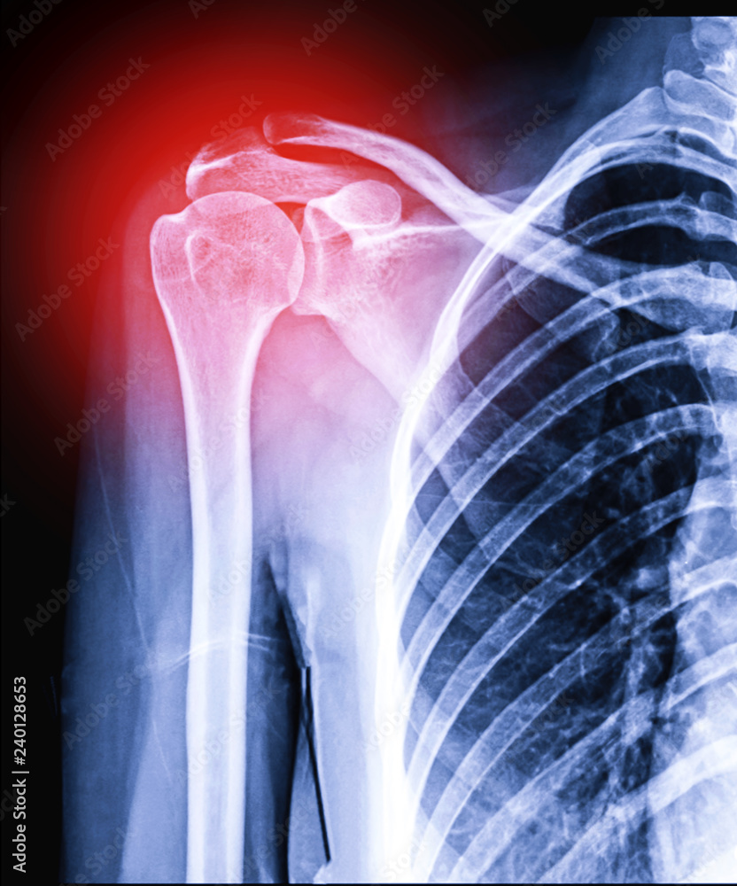 Radiographic Image Or X Ray Image Of Shoulder Joint Stock Photo Adobe Stock