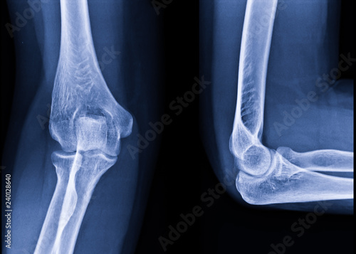 Canvas Print Radiography of Right elbow AP and Lateral position