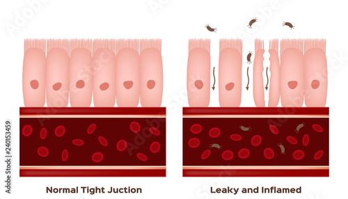Celiac disease Small intestine lining damage. good and damaged villi . leaky gut progression