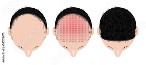 hair transplant vector 