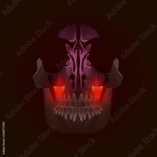 Medical illustration of the lines. Odontogenic sinusitis. Inflammation of the maxillary sinuses due to a disease of the roots of the tooth with a point of pain and inflammation. X-ray effect