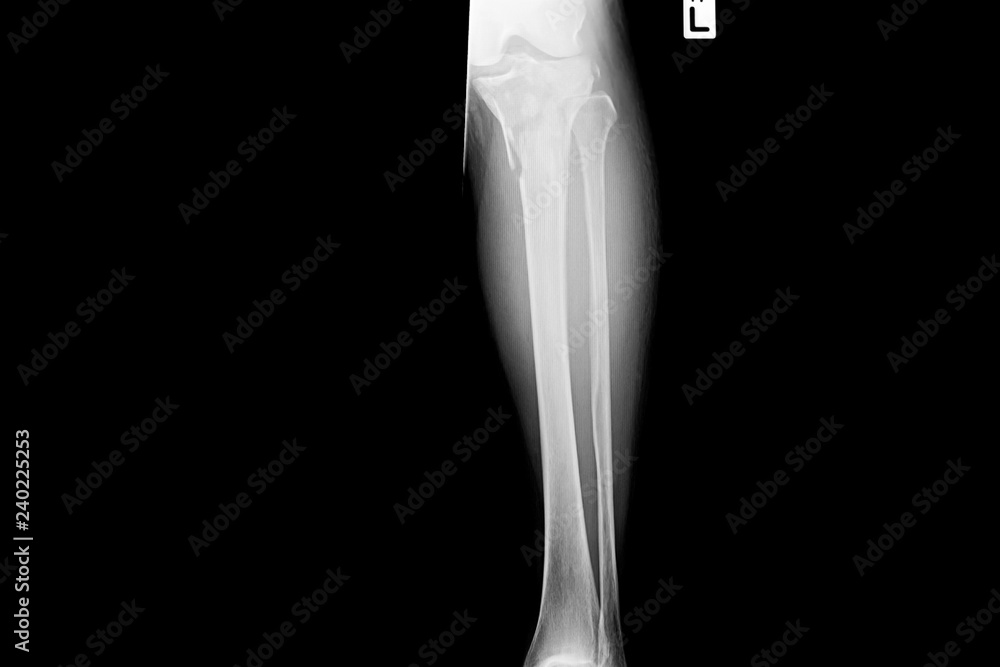 Poster Show image of tibia and fibula left lateral – Wall Art | UkPosters