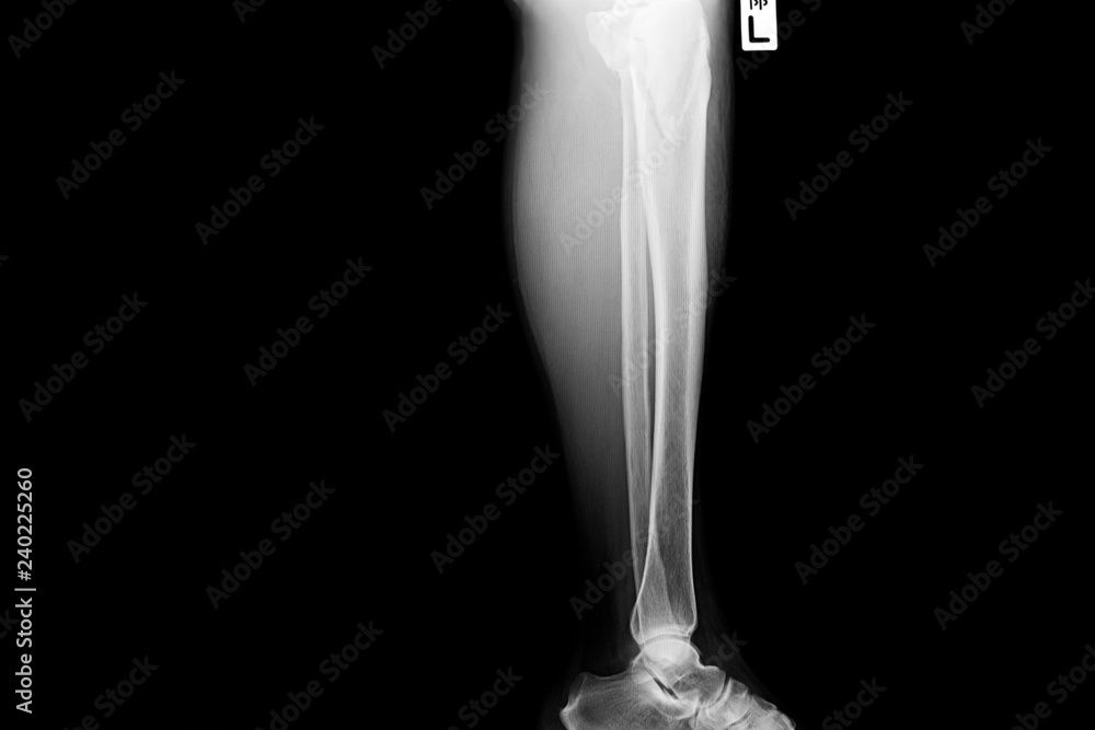 Show image of tibia and fibula left lateral Stock Photo | Adobe Stock
