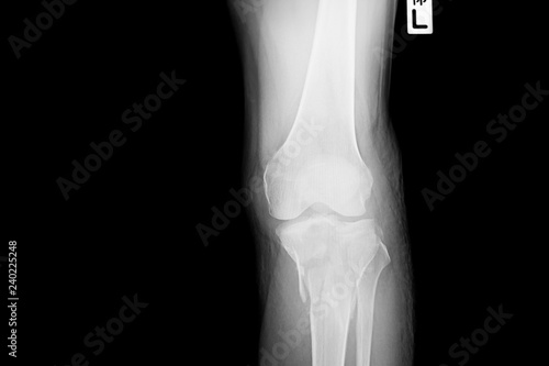 film X-ray image left Knee. X-ray of left knee of 51-year-old asian man from side.