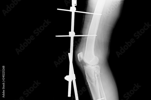 Show fracture tibia and fibula left lateral. X-ray image of fracture leg with implant external fixation.
