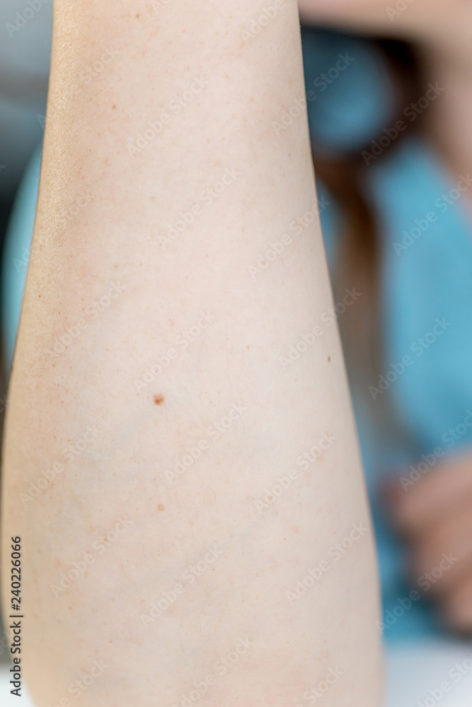 a birthmark or a mole on a woman skin a birthmark or a mole on a woman skin