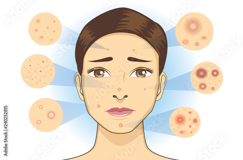 All Type of acne icon from facial skin of woman. Illustration about dermatology diagram.
