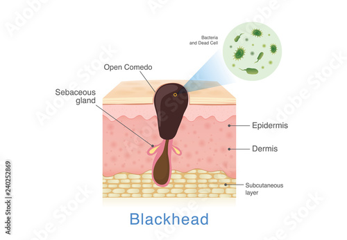 Bacteria in blackhead with human skin layer structure. Illustration about Acne from clogged in pore.