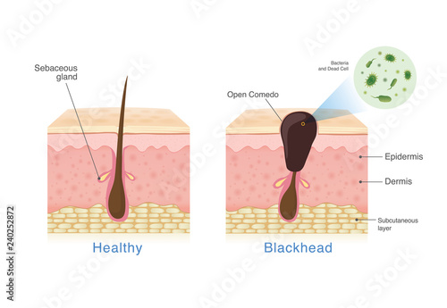 Bacteria in blackhead with human skin layer structure and Healthy skin. Illustration about dermatology diagram . photo