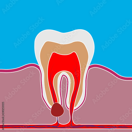 Flat style of dental disease with pain and inflammation. Medical illustration of tooth root inflammation, tooth root cyst, pulpitis.