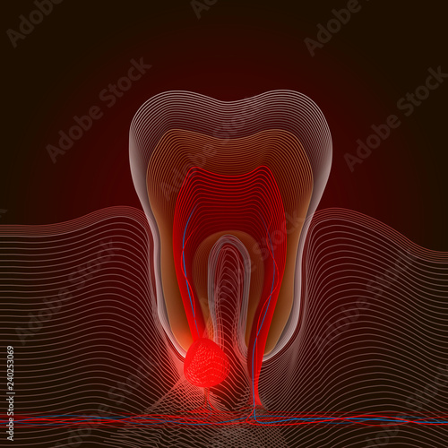 Linear stylization of dental disease with a point of pain and inflammation. Medical illustration of tooth root inflammation, tooth root cyst, pulpitis. X-ray effect
