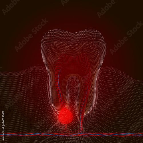 Point styling with a point of pain and inflammation. Medical illustration of tooth root inflammation, tooth root cyst, pulpitis. X-ray effect