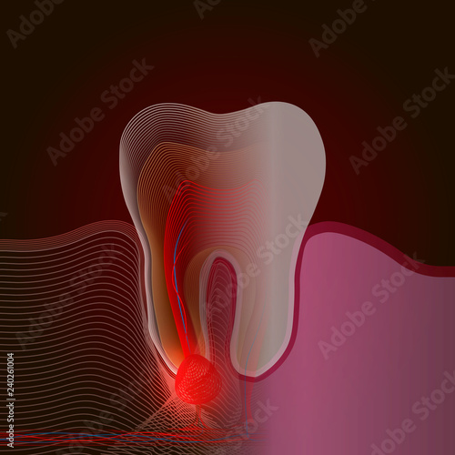 X-ray effect. The transition from a real tooth to a linear x-ray effect with a point of pain and inflammation. Medical illustration of tooth root inflammation, tooth root cyst, pulpitis.