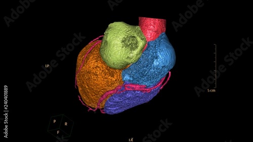 CTA Coronary artery colorful 3D rendering image. CT angiographphy for heart disease rotating on the screen . medical concept. photo