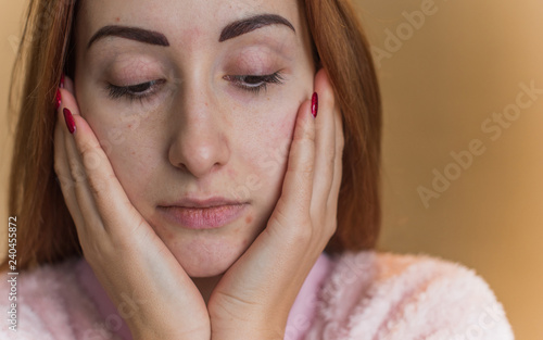 Картината върху платно Close up portrait of a woman with problematic skin