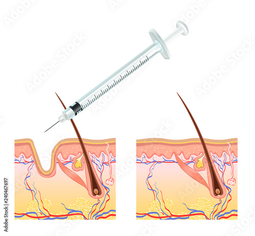 biorevitalization with hyaluronic acid treatment of mimic wrinkles under the eyes reduces unwanted signs of aging including wrinkles around eyes and mouth young skin results.