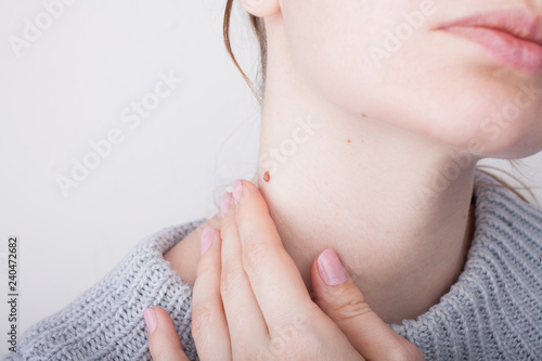 Girl with birthmarks on the neck photo