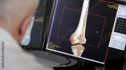 Pictures of the bone scan on the monitor.