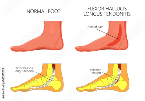 Vector illustration of  healthy human foot and a medial ankle injury. Flexor hallucis longus tendonitis