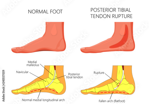 Vector illustration of  healthy human foot and a medial ankle injury. Posterior tibial tendon rupture