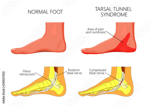 Vector illustration of  healthy human foot and a medial ankle injury. Tarsal tunnel syndrome photo