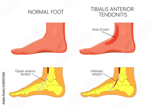 Vector illustration of  healthy human foot and a medial ankle injury. Tibialis anterior tendonitis