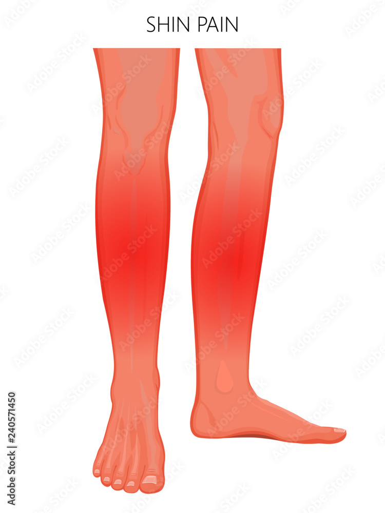 Vector illustration of a human legs (anterior and medial view) with shin pain. Vector illustration for advertising, medical (health care) publications Vector illustration of a human legs (anterior and medial view) with shin pain. Vector illustration for advertising, medical (health care) publications