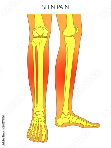 Vector illustration of bones of a human legs (anterior and medial view) with shin pain. Vector illustration for advertising, medical (health care) publications
