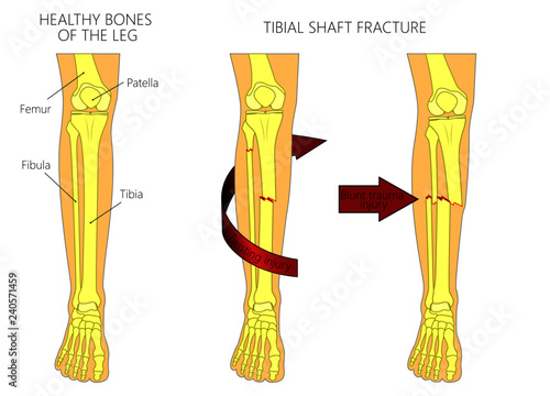 Vector illustration of a healthy bones of human leg and a leg with tibial shaft fracture. Twisting, blunt trauma injury. Front view of the foot with knee. For advertising, medical publications
