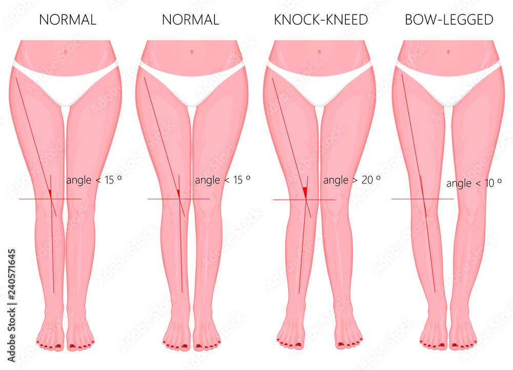 Vetor de Vector Illustration. Shapes of the legs. Normal and curved legs.  Knock knees. Bowed legs. Genu valgum and genu varum. For advertising,  medical (health care), publication. do Stock | Adobe Stock
