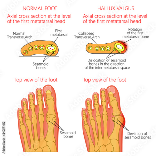 Vector illustration of a healthy human forefoot and a foot with hallux valgus, dislocation of sesamoid bones. Top view and cross section of of the foot. For advertising, medical publications