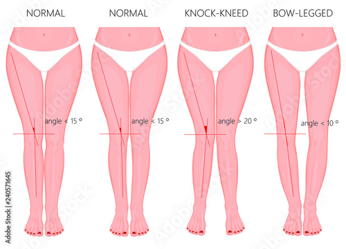 Vector Illustration. Shapes of the  legs. Normal and curved legs. Knock knees. Bowed legs. Genu valgum and genu varum.  For advertising, medical (health care),  publication.