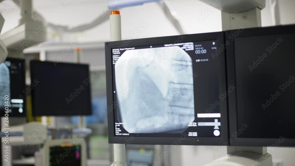 Monitor screen in radiology during heart surgery. Stock Video | Adobe Stock