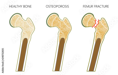 Vector illustration of a healthy human thigh bone,  osteoporosis of femur and femoral neck fracture with dislocation isolated on white background. For advertising and medical publications